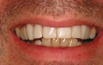 Glamsmile for Worn Down Teeth - after