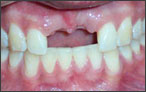 Cosmetic Dentistry for Missing Teeth - before