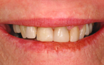 Porcelain Veneers Brisbane