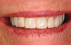 Brisbane 's cheapest porcelain veneers